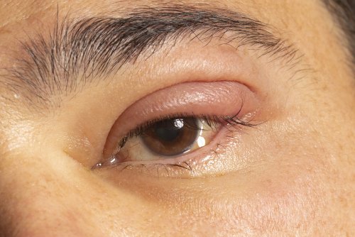 inflamed-eye-with-infected-stye-upper-eyelid-oph-2022-05-16-21-40-19-utc.JPG